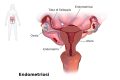 Endometriosi