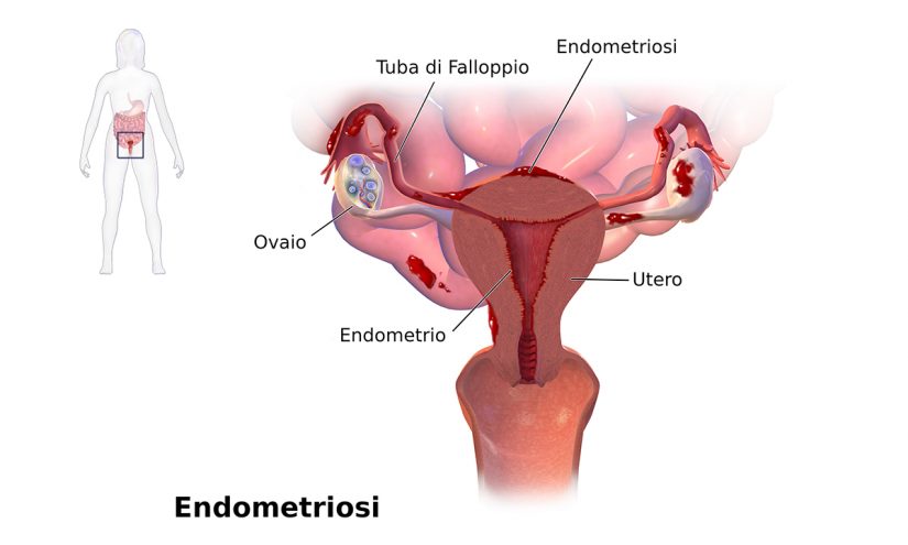 Endometriosi